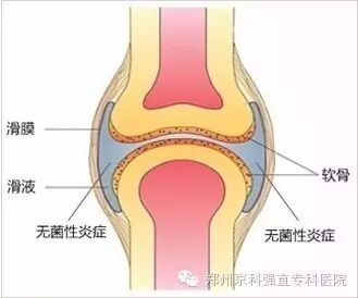 无菌性炎症.jpg